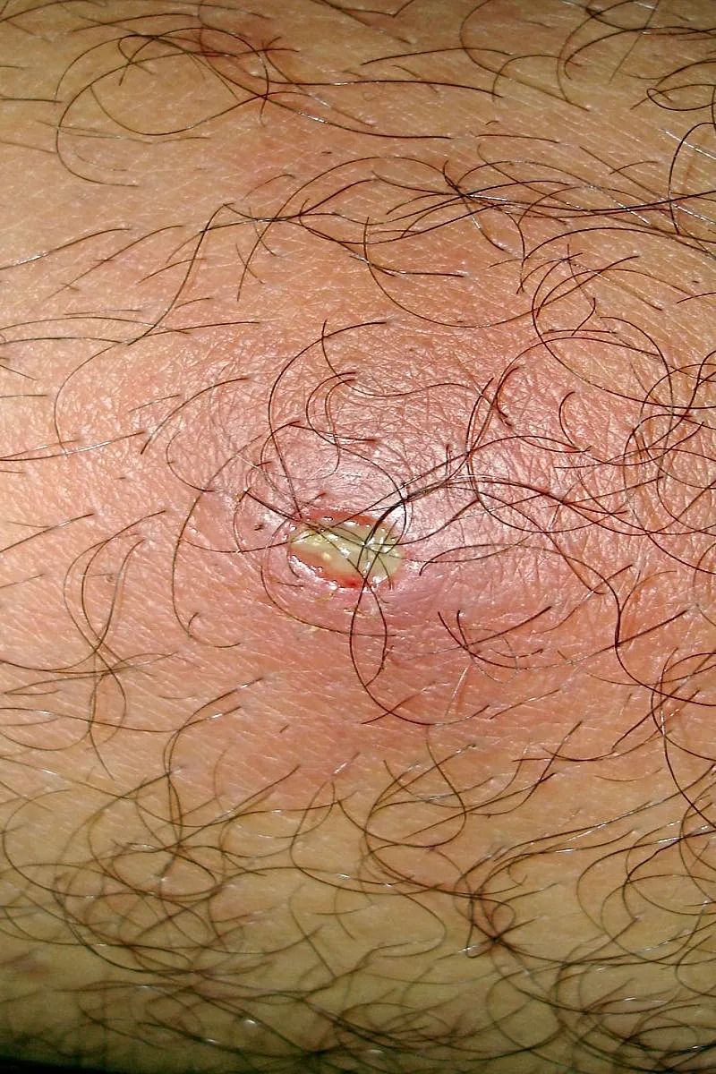 Largest Lipoma Removals (Full video)