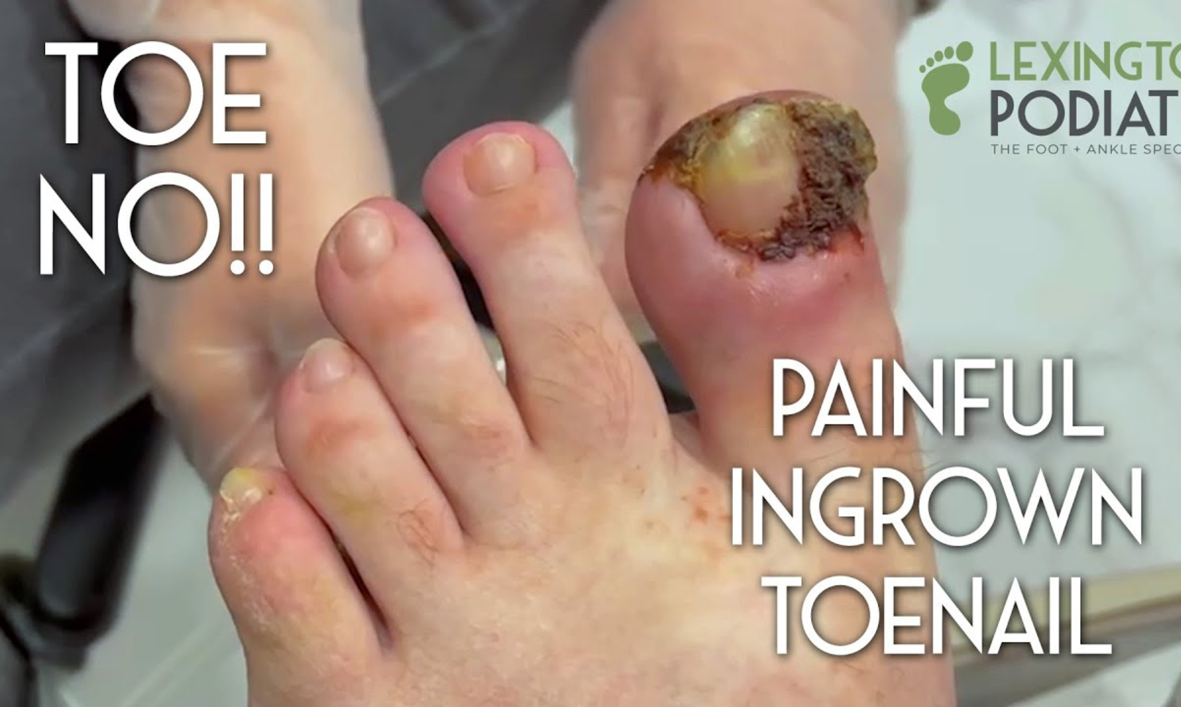How to Clean Your Nails and Toenails
