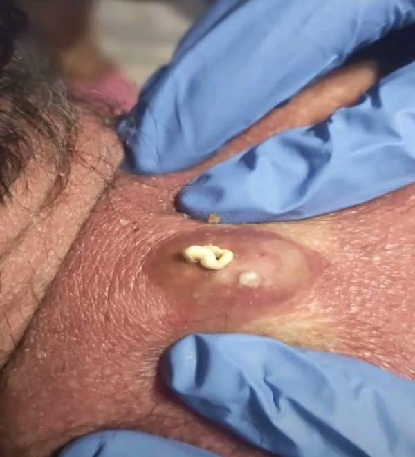 Treatment Options for Small Lumps and Cysts: A Complete Guide
