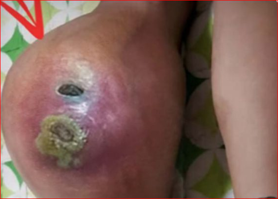 Dr. Blackhead Extractions EP:519 REMOVAL PIMPLE