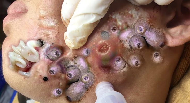 12 Ways to Get Rid of Whiteheads