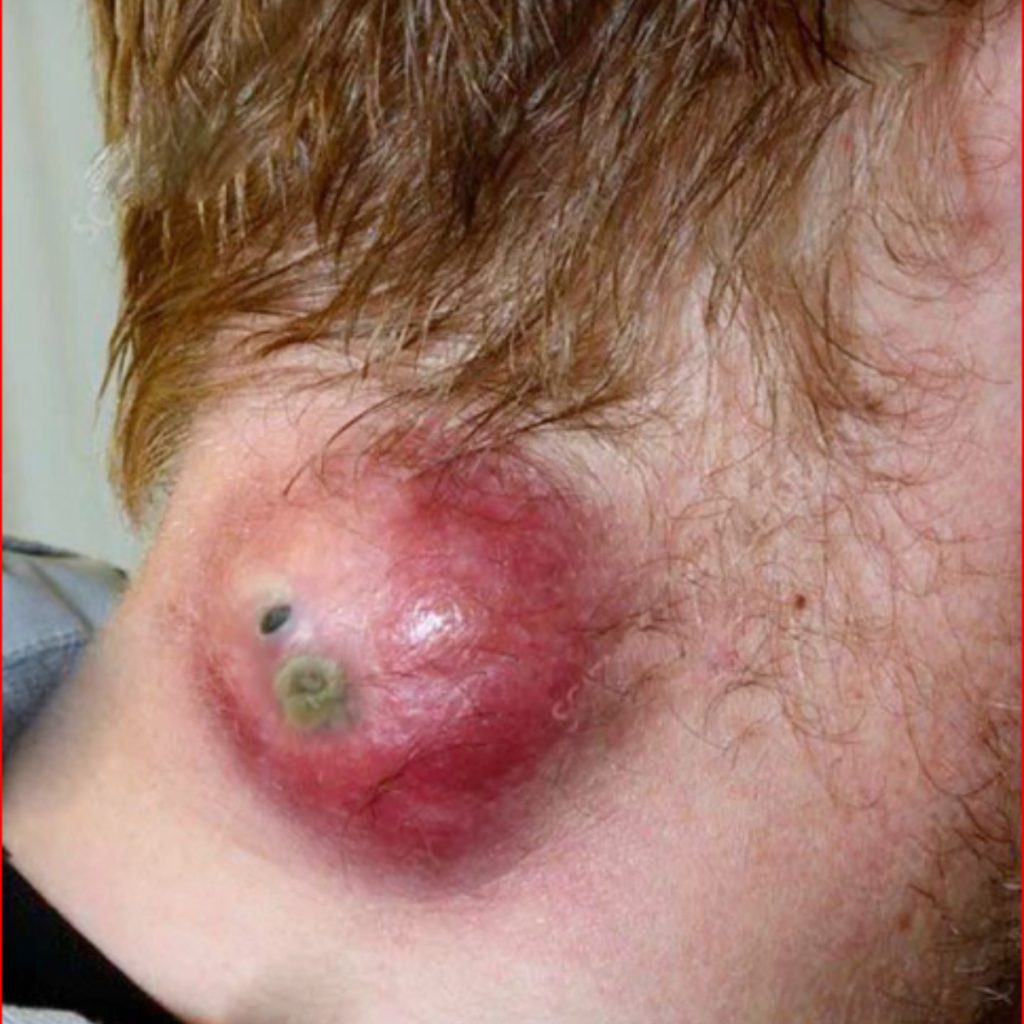 “Understanding Acne: Causes, Infections, and the Role of Hygiene”