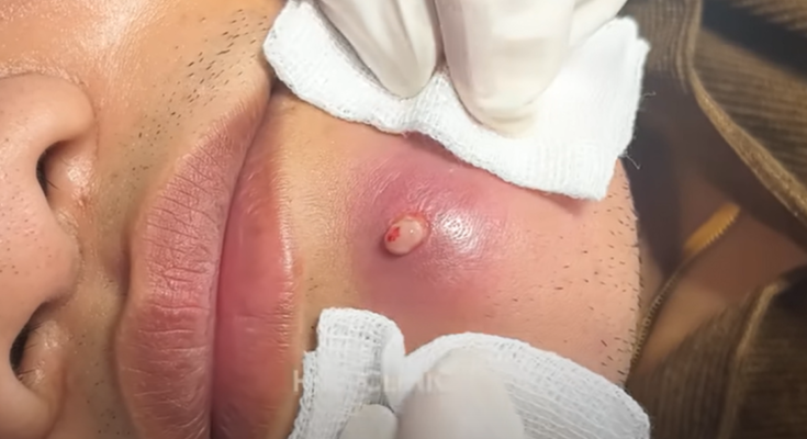 “How to Manage Cystic Acne and Blackheads: Topical and Professional Treatments”(Full video)