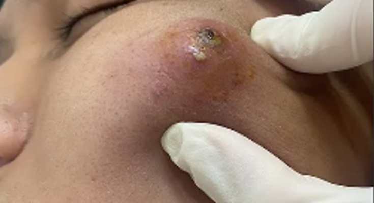 Dr. Blackhead Extractions EP:580 REMOVAL PIMPLE