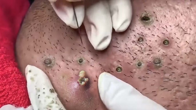 The Most Satisfying Blackhead Extractions: Deep Pore Cleansing for Clearer Skin