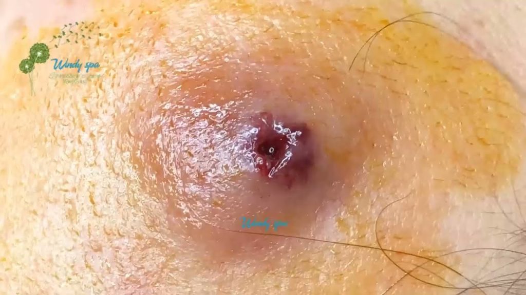 “Sebaceous Cyst Treatment Explained: From Home Care to Surgery”