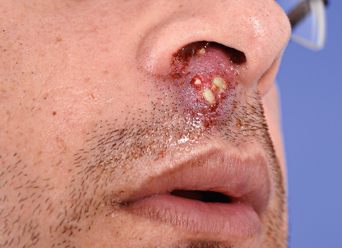 “Clear Skin Starts Here: Effective Blackhead Treatment Strategies”