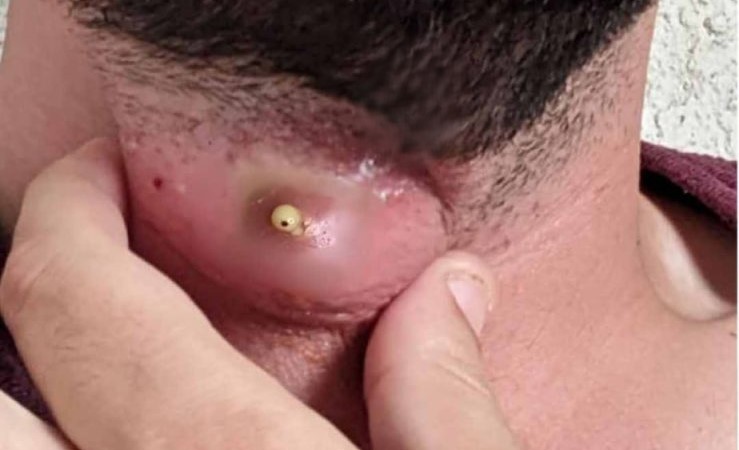 “Varicella-Related Abscesses: Diagnosis, Treatment, and Prevention Strategies”