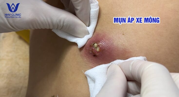 “Dealing with Cystic Acne: Proven Methods to Reduce Giant Pimples”