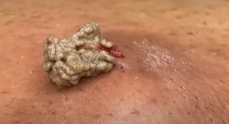 “Comprehensive Guide to the Safe Removal of Large Skin Cysts”