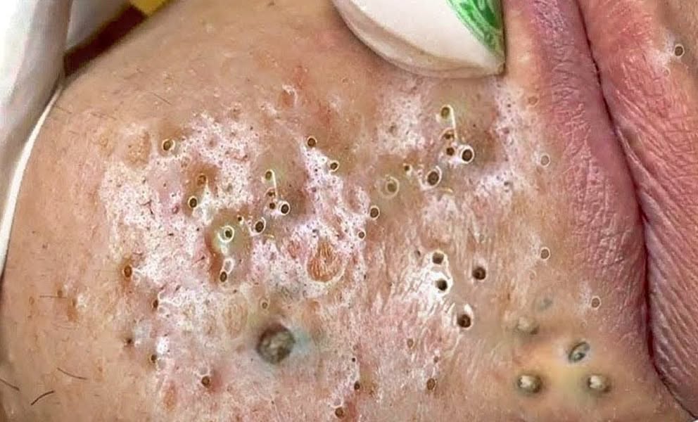 “The Ultimate Guide to Getting Rid of Blackheads: Dermatologist-Backed Skincare Tips”