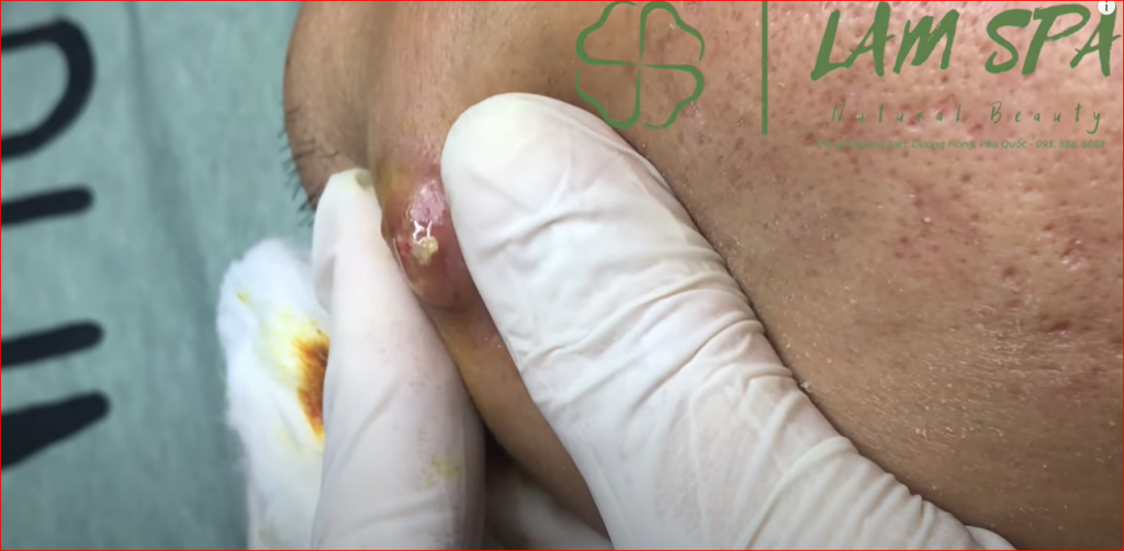 “Complete Treatment Guide for Huge Blackheads on the Face”