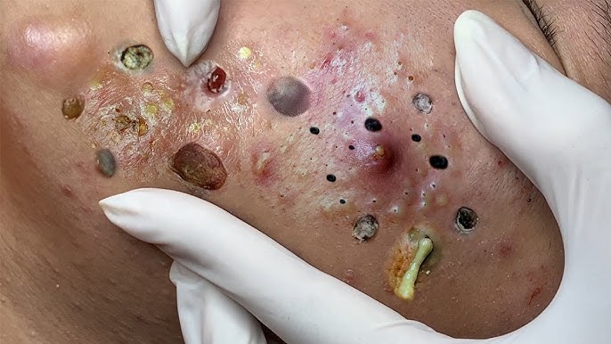 How to Safely Remove a Giant Blackhead: Step-by-Step Treatments, Tools & Product Guide